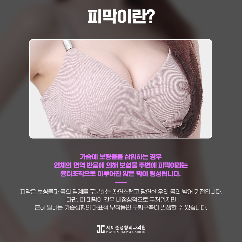 가슴보형물제거 어떤 수술일까? 관련 이미지 4