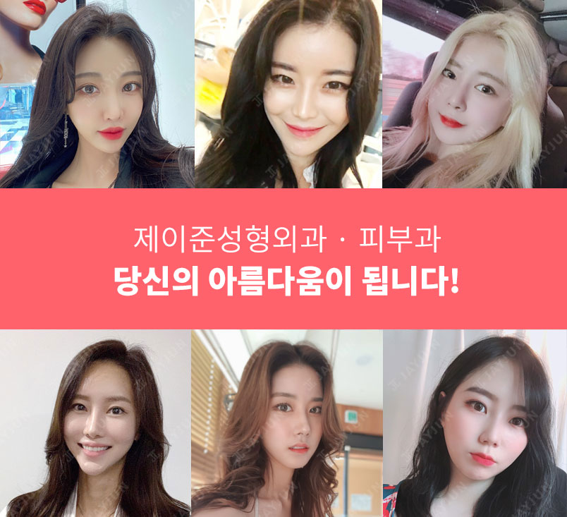 제이준피부과 2020여름이벤트, 입술필러가격은!? 관련 이미지 7