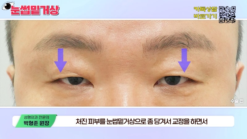 [Jayjun Plastic Surgery & Dermatology] Worried about drooping eyelids? Solve sagging eyes with a brow lift under the eyebrows without double eyelid surgery! image 16