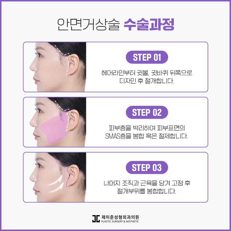 동안으로 거듭나는 안면거상술 관련 이미지 4