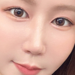 상안검과 하안검이란? 관련 이미지 15