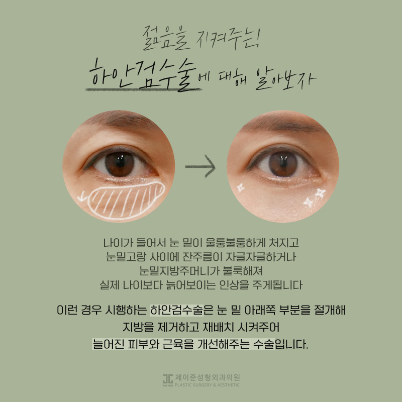 상안검과 하안검이란? 관련 이미지 4