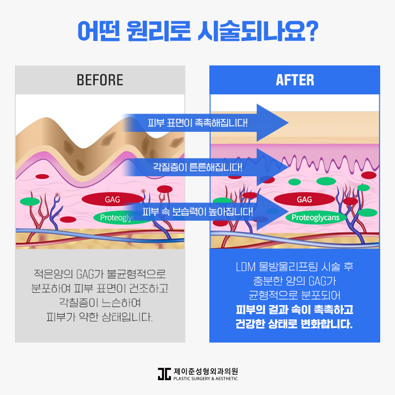 언주피부과 ldm물방울리프팅 관련 이미지 6