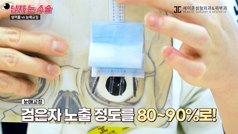 [제이준성형외과&middot;피부과] 남자 눈을 키우는 두 가지 방법! 쌍꺼풀 vs 눈매교정 관련 이미지 10