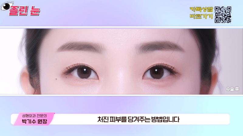 [제이준성형외과&middot;피부과] 졸려보이는 눈과 이마 주름의 상관관계? 관련 이미지 13