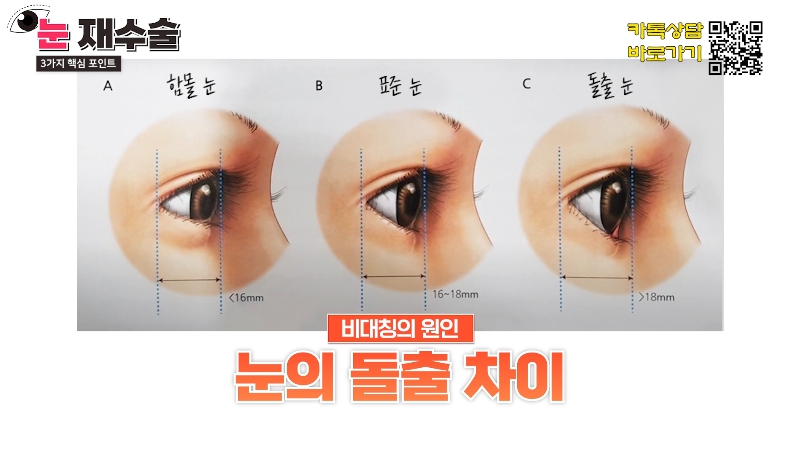 [제이준 유튜브] 눈 재수술을 막기위한 3가지 포인트! 관련 이미지 9