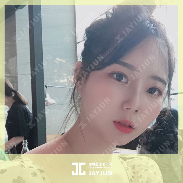 울쎄라 비용 가격 알아보는 방법 관련 이미지 2