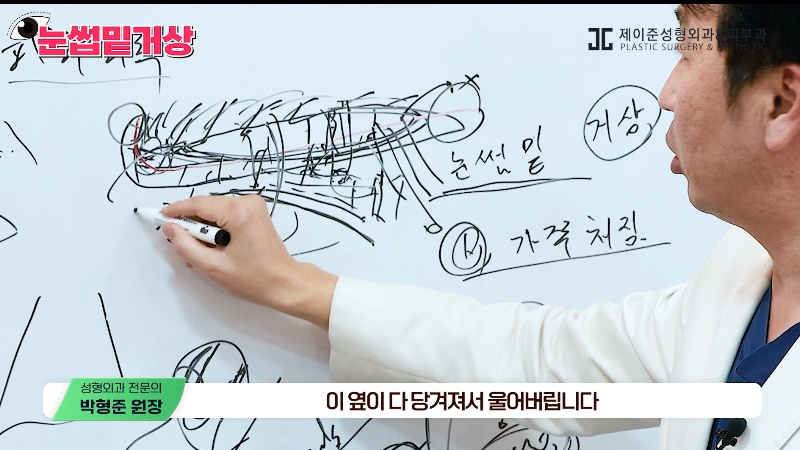 [제이준성형외과&middot;피부과] 쌍꺼풀 라인 변화 없이 눈매 개선은 확실하게! #눈썹밑거상 관련 이미지 19