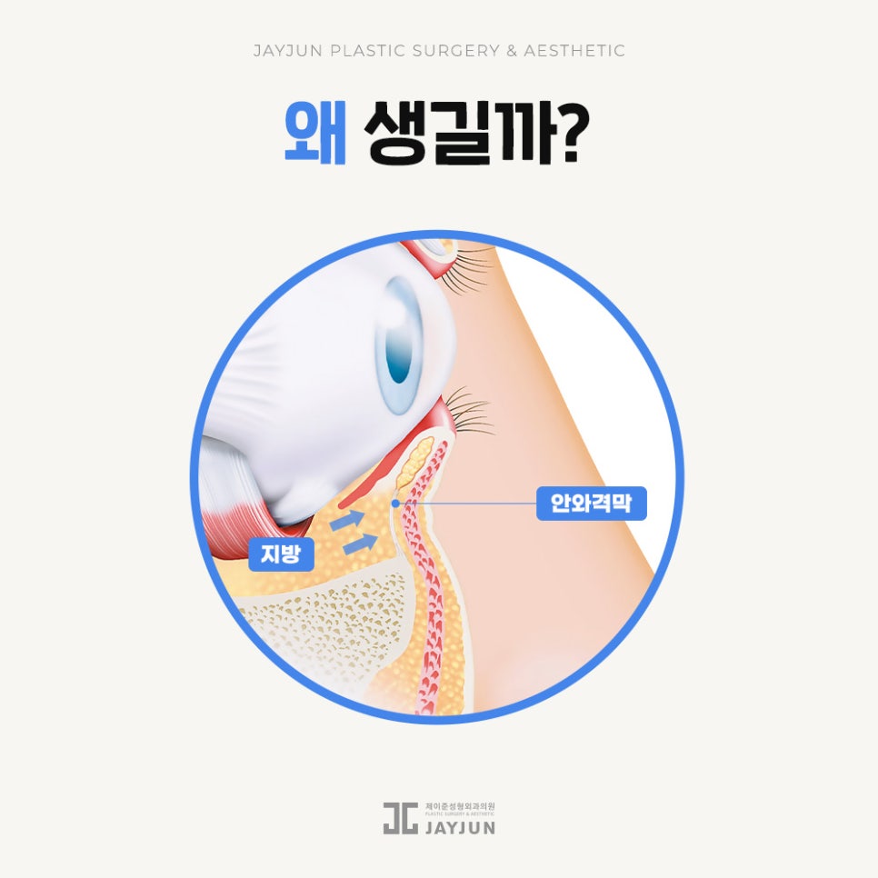[Jaejun Plastic Surgery & Dermatology] Under-eye fat: Under-eye fat repositioning vs. lower blepharoplasty — which procedure is right for me? image 2