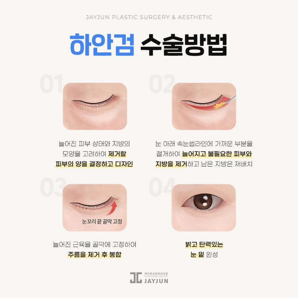 [Jaejun Plastic Surgery & Dermatology] Under-eye fat: Under-eye fat repositioning vs. lower blepharoplasty — which procedure is right for me? image 5