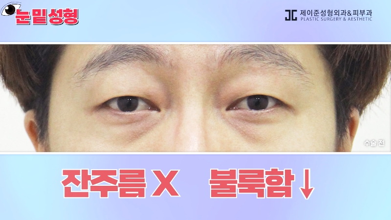 [Jeijun Plastic Surgery & Dermatology&middot;] Lower Blepharoplasty? Lower Eyelid Fat Repositioning? Read This Before Deciding! image 22