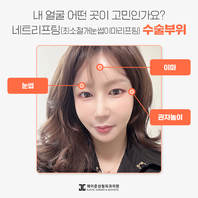 네트리프팅 어떤 수술일까? 관련 이미지 4