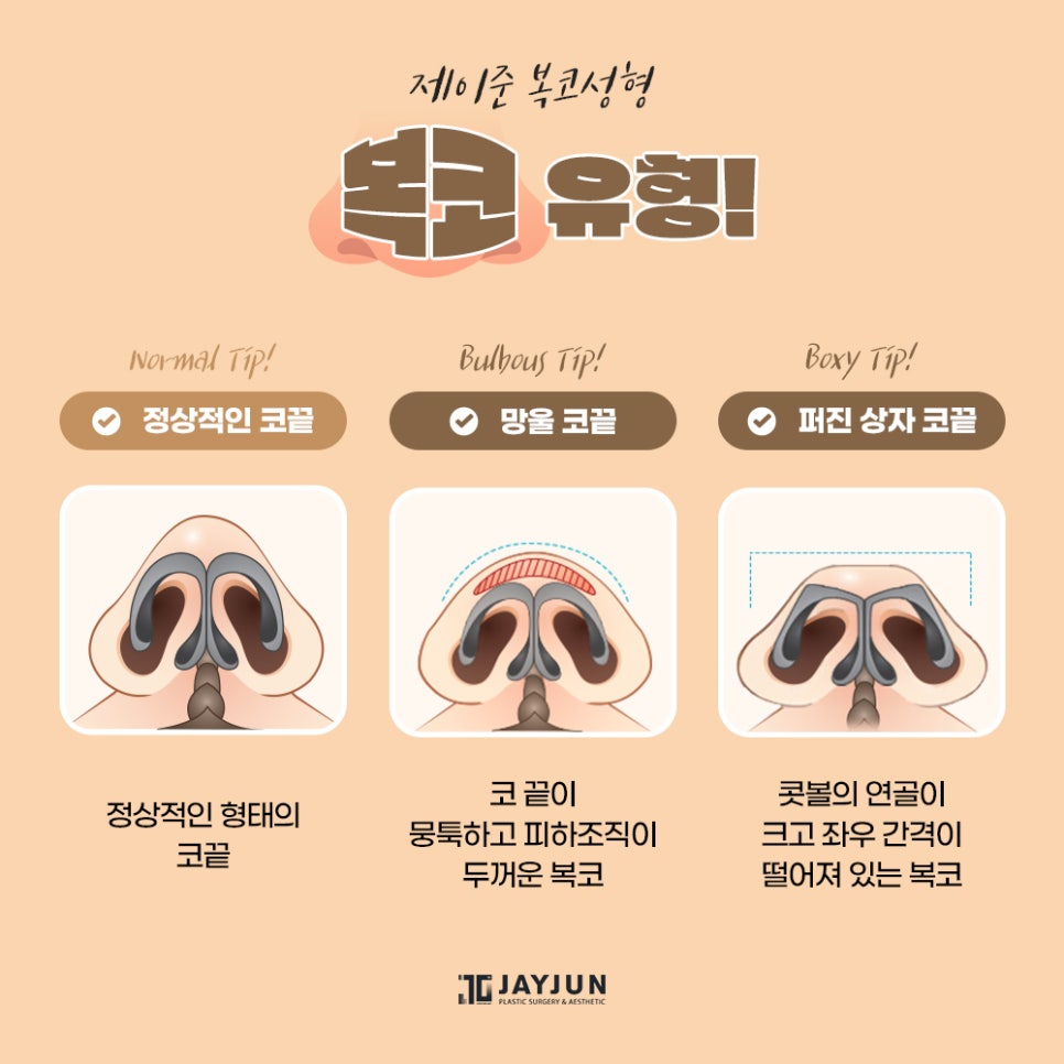 [제이준성형외과] 어떤 각도에서도 자신있는! 제이준 복코 성형 관련 이미지 5