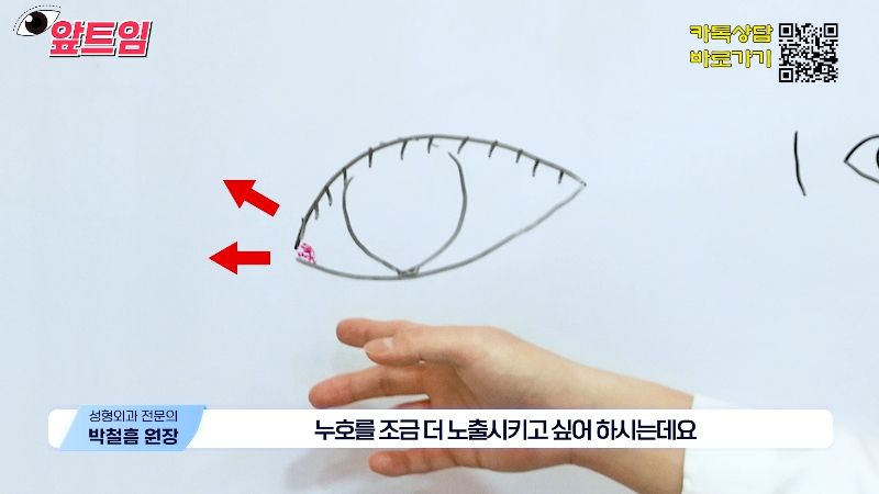 [Jaejune Plastic Surgery & Dermatology] Why is epicanthoplasty necessary? Everything about epicanthoplasty!! image 10