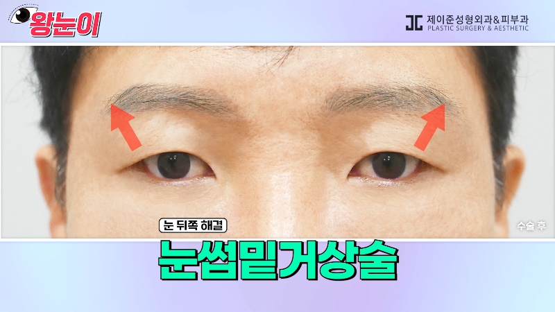 [제이준성형외과&middot;피부과] 제이준성형외과 박철흠 원장님이 알려주는 눈이 커지는 방법 핵심요약! 관련 이미지 18