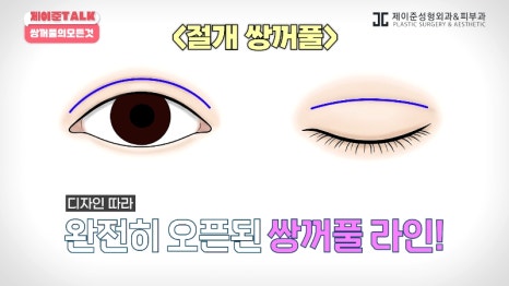 [제이준성형외과&middot;피부과] 비절개&middot;부분절개&middot;절개 쌍꺼풀의 원리와 차이점! 관련 이미지 19