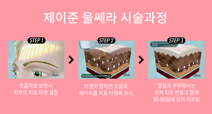 강남 제이준피부과 울쎄라로 이중턱없애기 관련 이미지 5