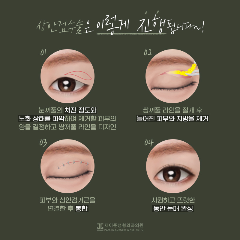 상안검과 하안검이란? 관련 이미지 6