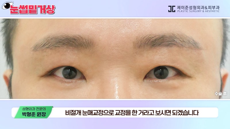 [Jayjun Plastic Surgery & Dermatology] Worried about drooping eyelids? Solve sagging eyes with a brow lift under the eyebrows without double eyelid surgery! image 17