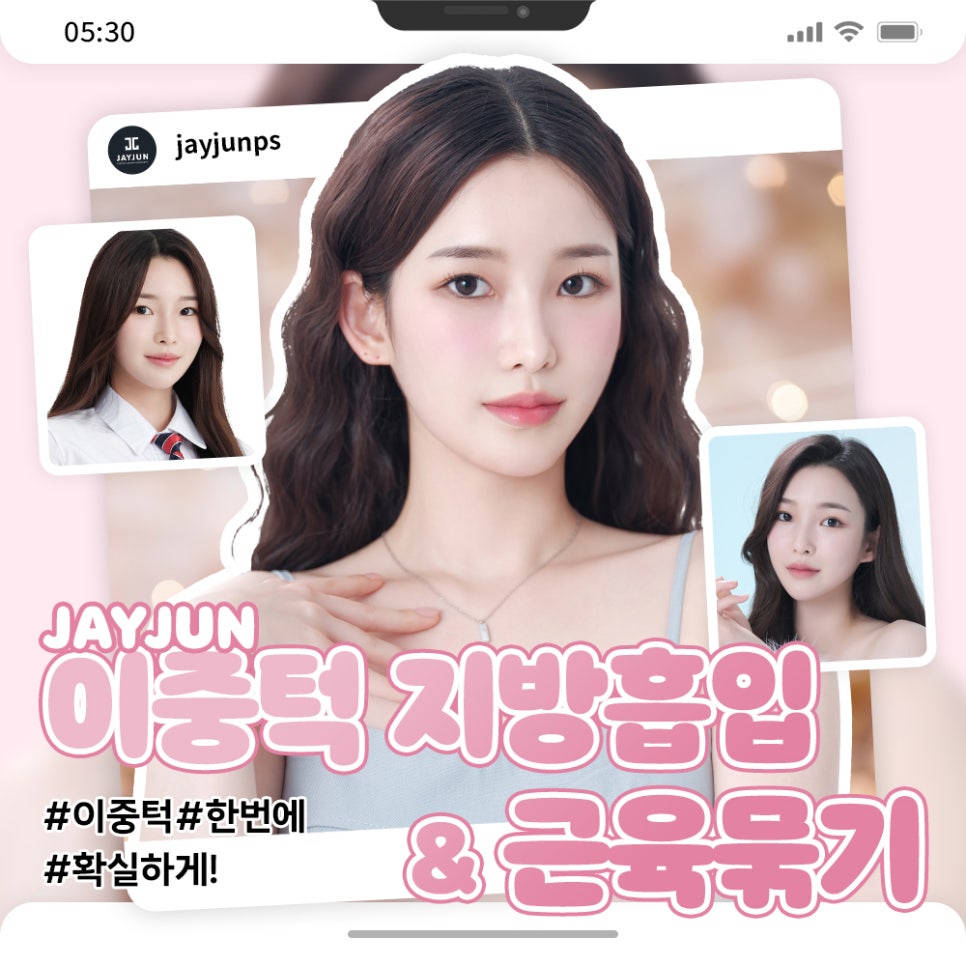 한번에 확실하게! 제이준 이중턱 지방흡입 & 근육묶기 관련 이미지 1