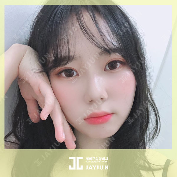 울쎄라 비용 가격 알아보는 방법 관련 이미지 3