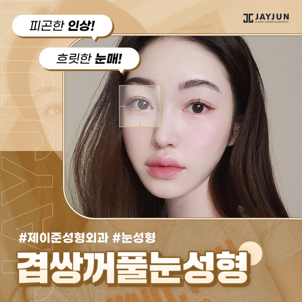 피곤한 인상! 흐릿한 눈매! 제이준 #겹쌍꺼풀 눈성형 관련 이미지 1