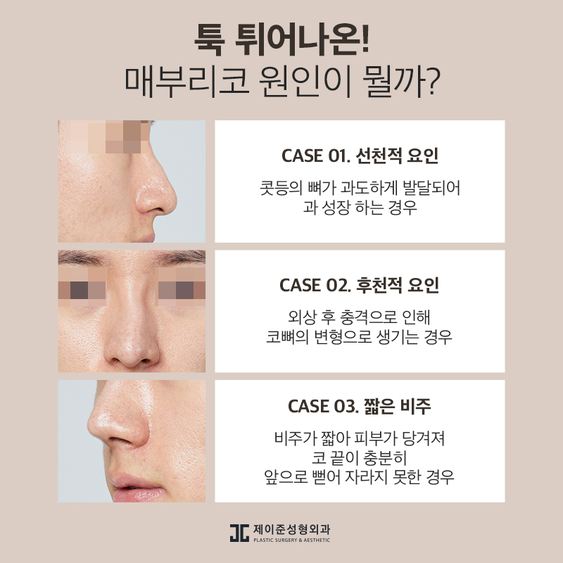 매부리코 교정 , 유형과 상태에 따라 진행돼야 관련 이미지 3