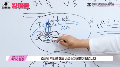 [제이준성형외과&middot;피부과] 쌍꺼풀 수술 vs 쌍꺼풀+눈매교정! 눈매교정 함께 하면 좋은 이유! 관련 이미지 13