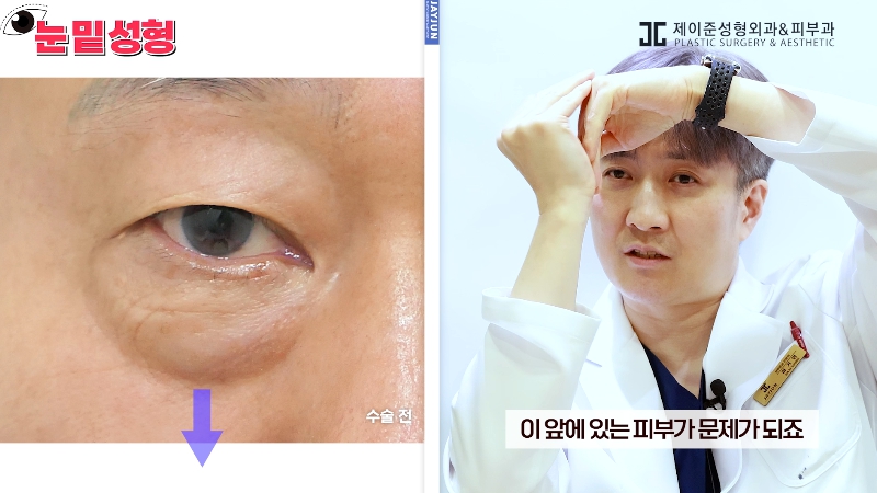 [Jeijun Plastic Surgery & Dermatology&middot;] Lower Blepharoplasty? Lower Eyelid Fat Repositioning? Read This Before Deciding! image 7