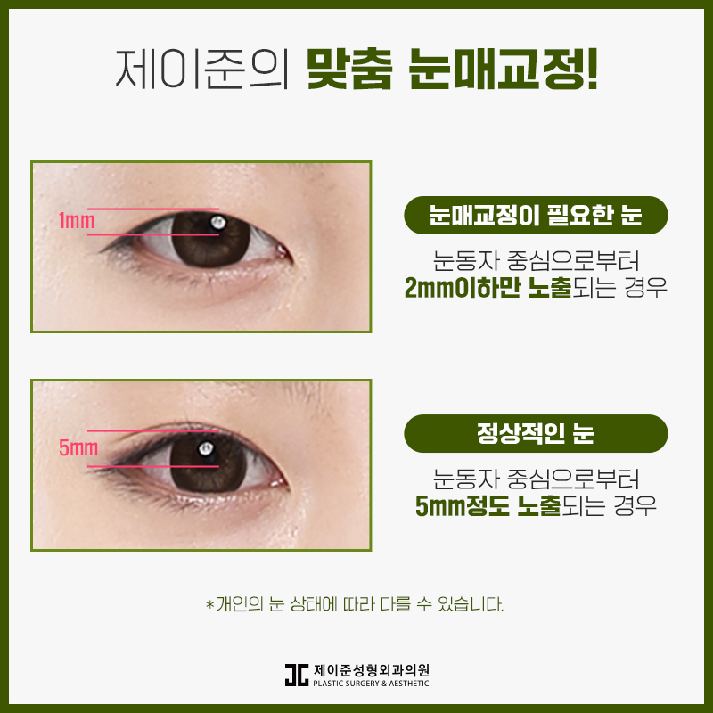 또렷한 눈을 위한 눈매교정 알아보기 관련 이미지 3