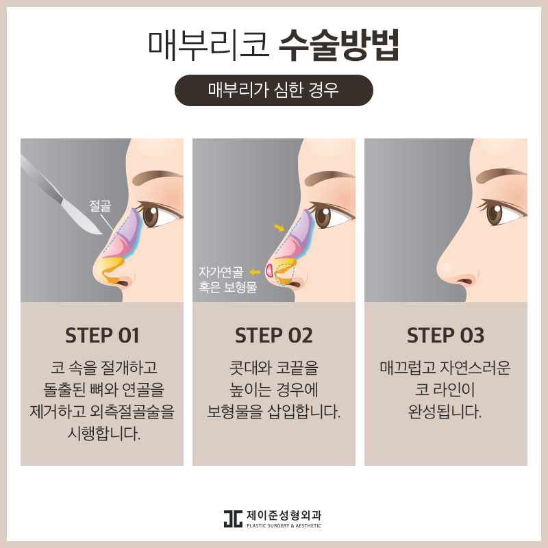 매부리코 교정 , 유형과 상태에 따라 진행돼야 관련 이미지 6