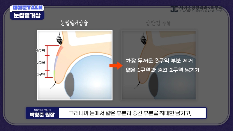 [Jaejune Plastic Surgery & Dermatology] The Secret to a Cleaner Eye Area Without Looking Obvious. #BrowboneLift image 9