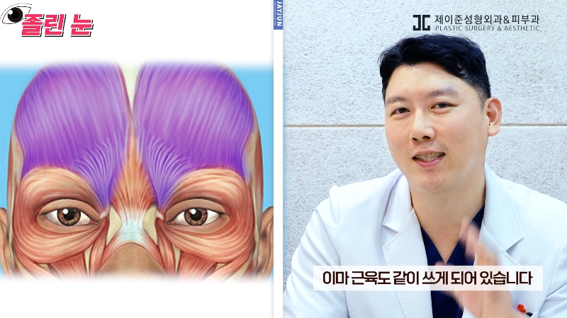 [제이준성형외과&middot;피부과] 졸려보이는 눈과 이마 주름의 상관관계? 관련 이미지 3