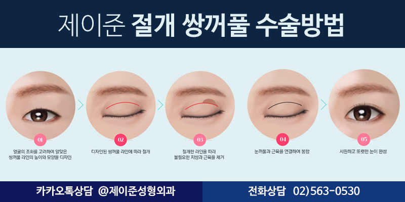 [제이준성형외과] 강남역 쌍수,  자연스러운 변화를 얻으려면? 관련 이미지 4