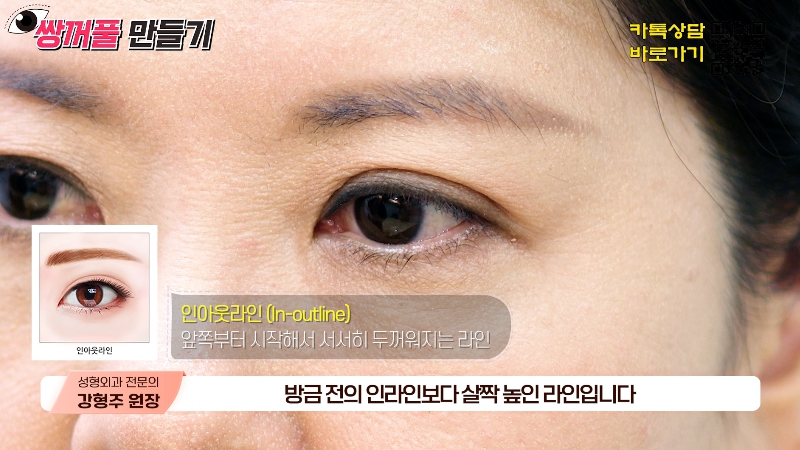 [제이준성형외과&middot;피부과] 내 눈에 찰떡인 쌍꺼풀 라인! 미리 찾아보기👀 관련 이미지 9