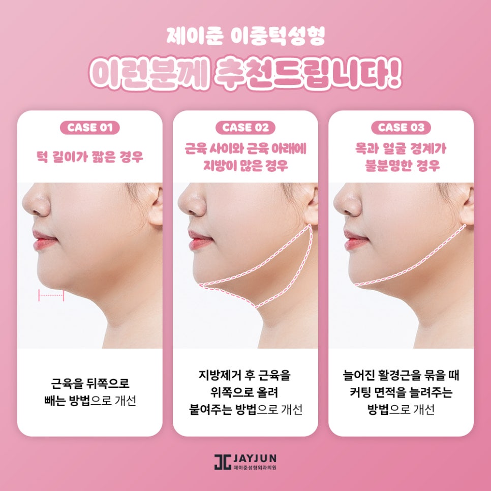 한번에 확실하게! 제이준 이중턱 지방흡입 & 근육묶기 관련 이미지 6