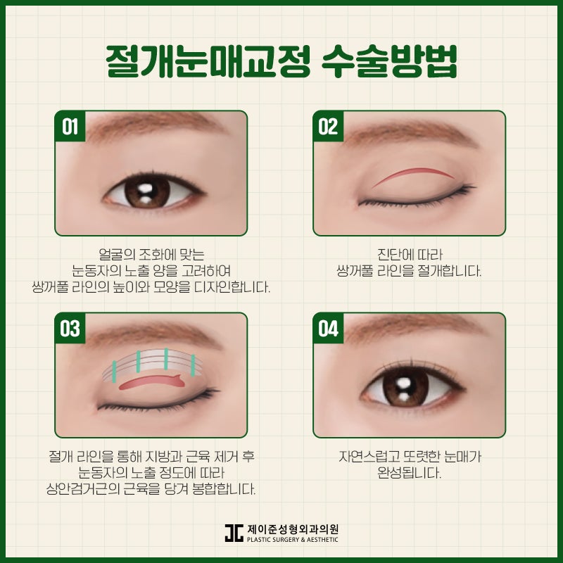 눈매교정 , 절개 / 비절개 차이점은? 관련 이미지 6