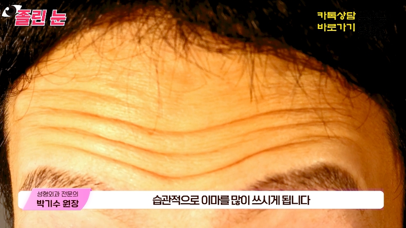 [제이준성형외과&middot;피부과] 졸려보이는 눈과 이마 주름의 상관관계? 관련 이미지 5