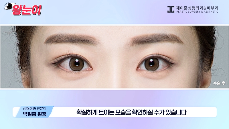 [제이준성형외과&middot;피부과] 제이준성형외과 박철흠 원장님이 알려주는 눈이 커지는 방법 핵심요약! 관련 이미지 7