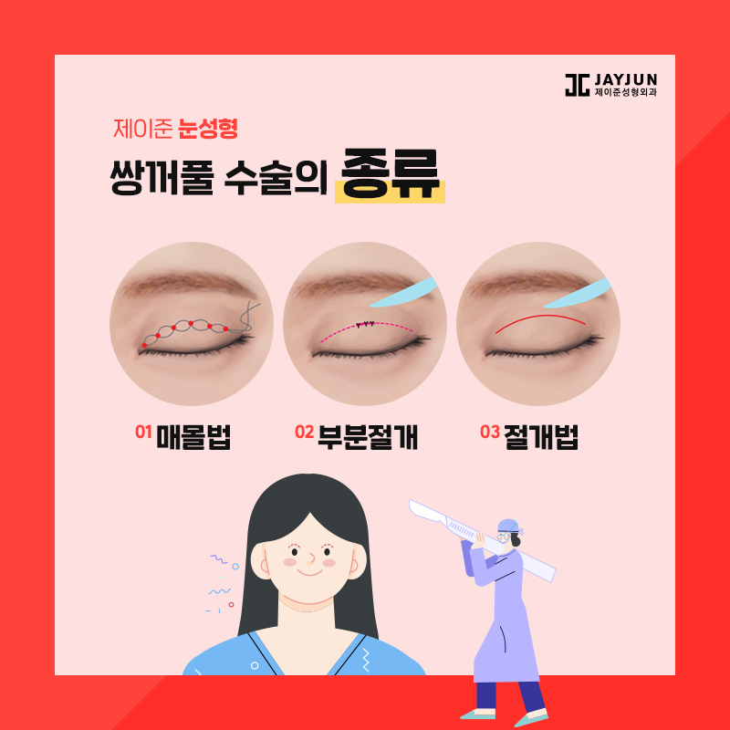 쌍꺼풀수술 종류 알아보기 관련 이미지 2