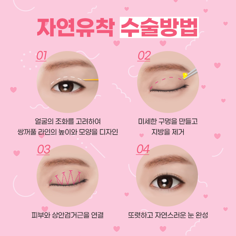 자연스러운 눈매를 위한 제이준 자연유착 관련 이미지 3