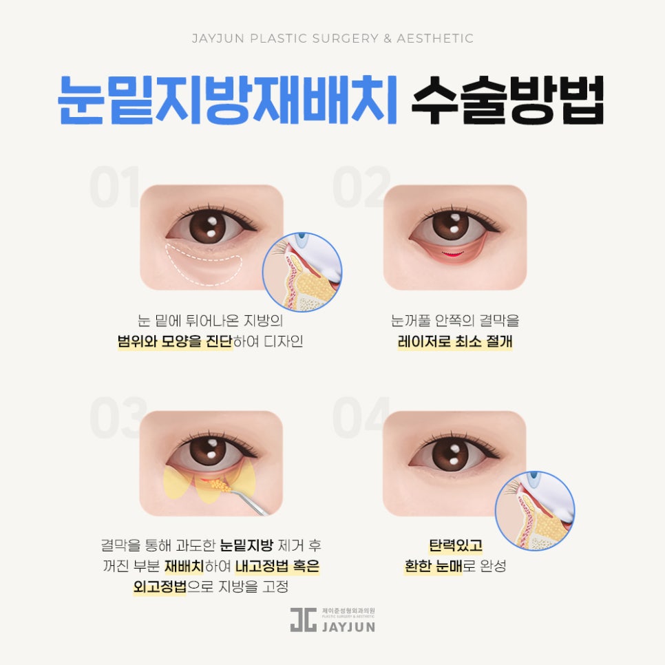 [Jaejun Plastic Surgery & Dermatology] Under-eye fat: Under-eye fat repositioning vs. lower blepharoplasty — which procedure is right for me? image 4