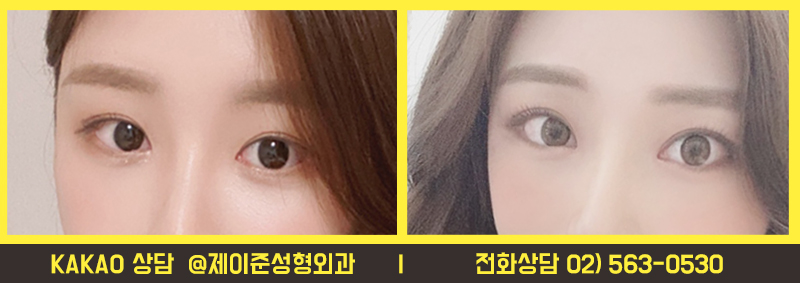 강남역쌍수, 자연유착 할거면 꼭 알아야할 점 관련 이미지 4