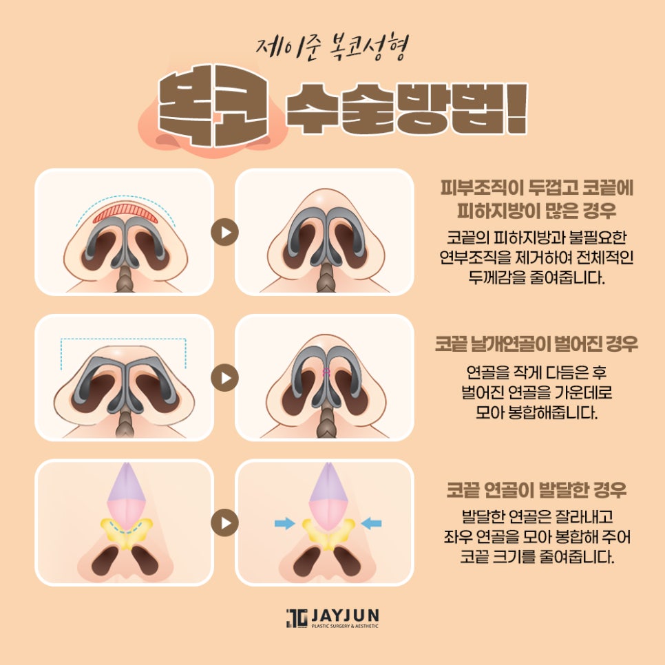 [제이준성형외과] 어떤 각도에서도 자신있는! 제이준 복코 성형 관련 이미지 6