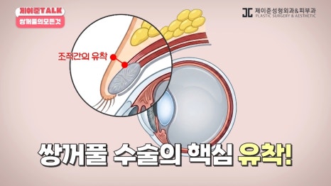 [제이준성형외과&middot;피부과] 비절개&middot;부분절개&middot;절개 쌍꺼풀의 원리와 차이점! 관련 이미지 3