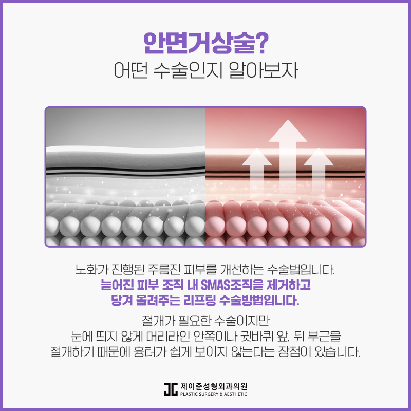 동안으로 거듭나는 안면거상술 관련 이미지 2
