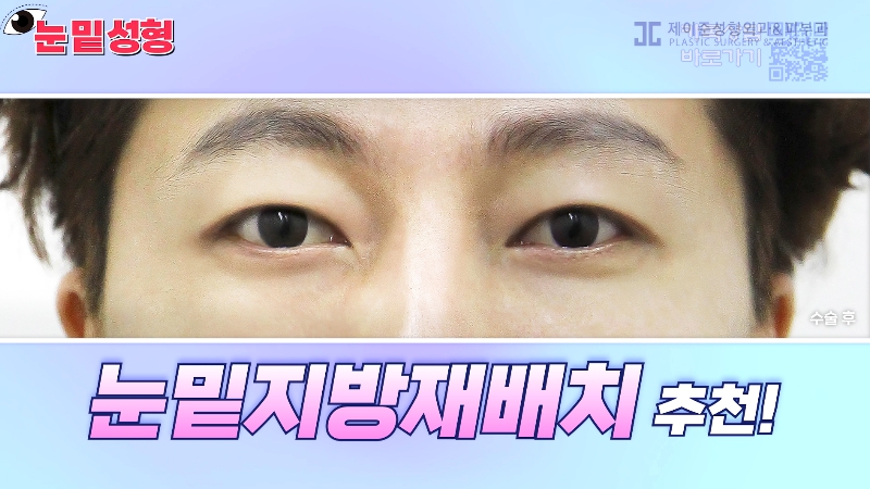 [Jeijun Plastic Surgery & Dermatology&middot;] Lower Blepharoplasty? Lower Eyelid Fat Repositioning? Read This Before Deciding! image 23
