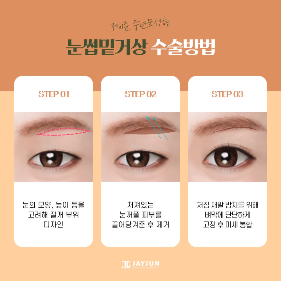 [제이준성형외과] 주름개선과 동안눈매를 한번에! 중년눈성형 눈썹밑거상 관련 이미지 5