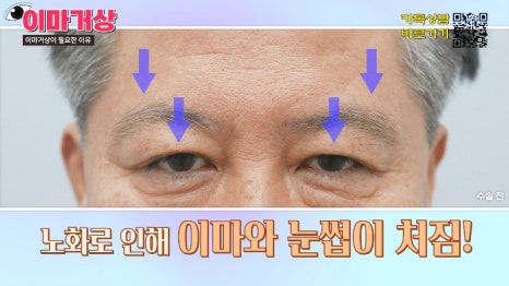 [제이준 유튜브] 쌍수 하러  갔는데 이마거상을 추천하는 이유?! 관련 이미지 5