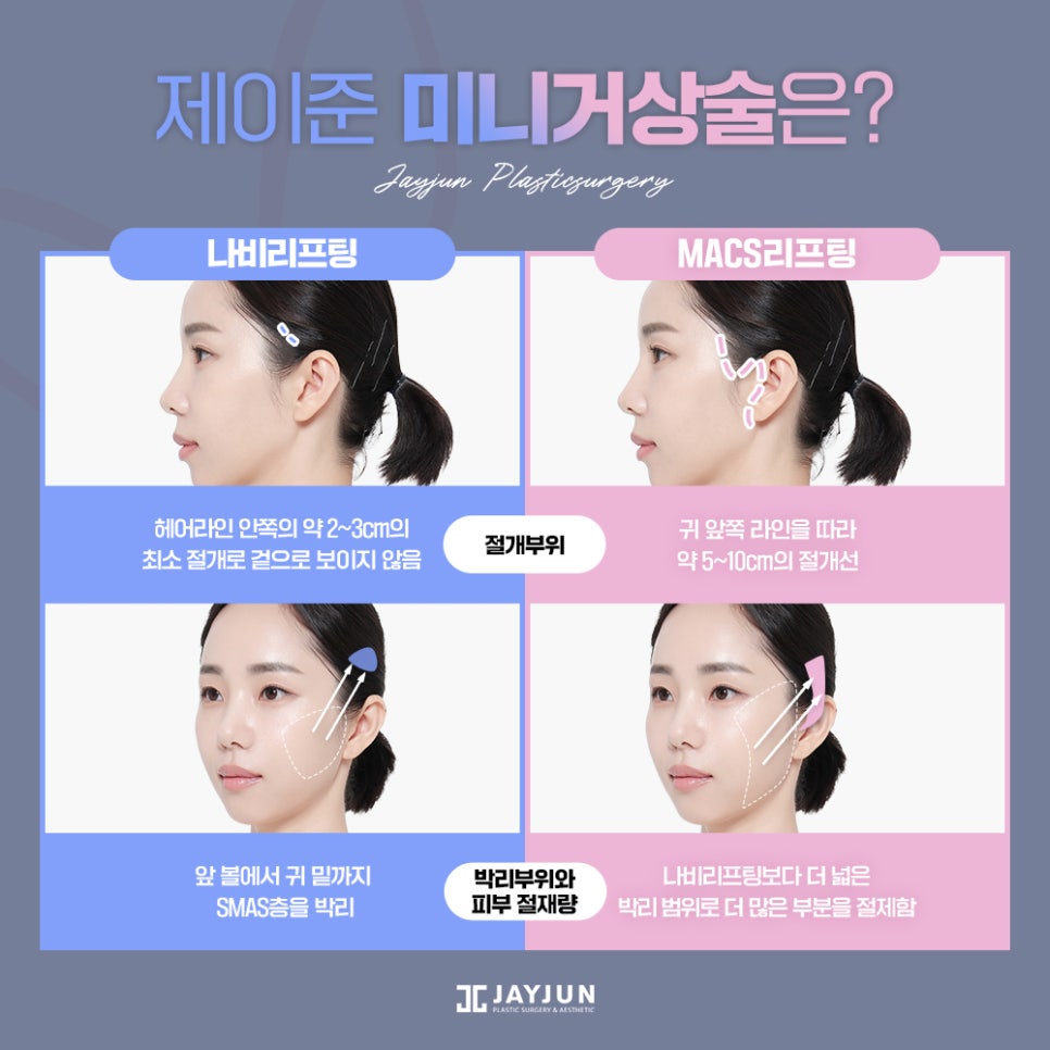 #중안면부 #나비존 #최소절개리프팅 제이준 나비리프팅 관련 이미지 5